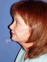 Eyelid Surgery (Blepharoplasty), Face Lift 636495