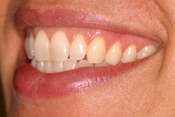 Invisalign after 119943