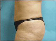true tumescent lipo after 269160