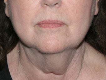 Liposculpture before 486632