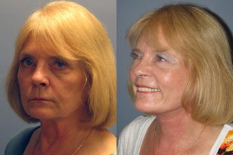 Lite Lift™, liposuction of the neck after 523704