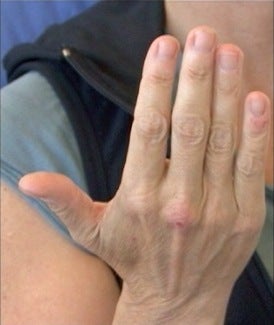 Radiesse Hand Rejuvenation before 371749