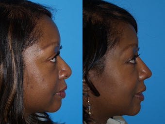 Ethnic Rhinoplasty before 640411