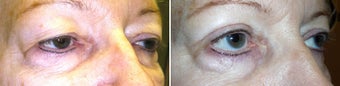 Cosmetic eyelid surgery before 128411