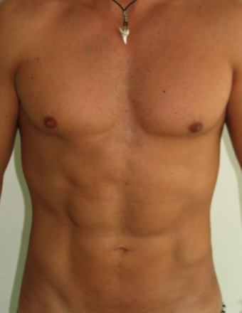 Tummy Liposuction after 229657