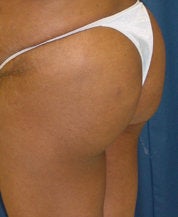 Brazilian Butt Lift after 101295