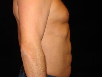 Liposuction of Abdomen, Waist, Flanks, Pecs and 6 Pack Abdominal Etching after 203544
