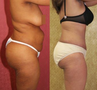 tummy tuck 304701