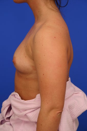 Breast Implants 415396