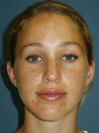 Rhinoplasty with sculpting of nasal tip and refinement of nasal dorsum. before 249027