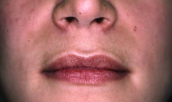 Lip Augmentation before 149213
