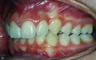 Orthodontic braces to correct a Class II malocclusion before 404703
