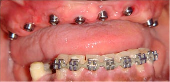 Dental Implants to replace full arch of teeth before 328056