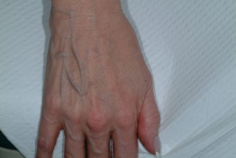 Sclreotherapy for the hands before 92032