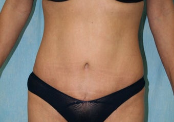 Local Anaesthetic Tummy Tuck after 344435