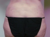 Liposuction after 272088