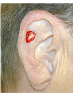 Skin cancer reconstruction on ear before 84497