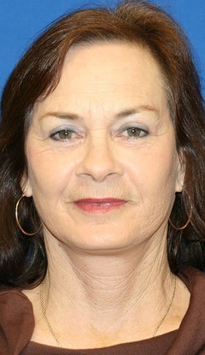 6 months post op: Facelift, Fat Transfer, Upper Bleph., Skin Pinch, & Chemical Peel after 424205