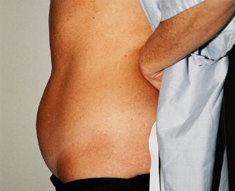 Mini-abdominoplasty before 493658