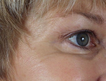Botox to the crow's feet after 240878