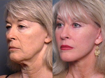 Brow lift after 337416