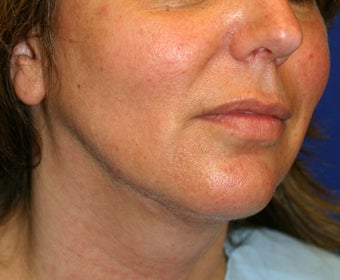 Neck Liposuction after 531701
