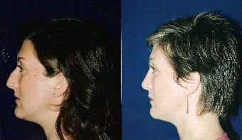 Rhinoplasty and Septoplasty after 241677