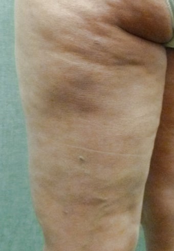 Cellulaze 571586
