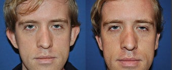 Otoplasty before 633523