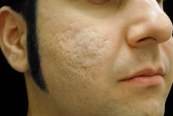 CO2 Affirm - Acne Scars before 200609