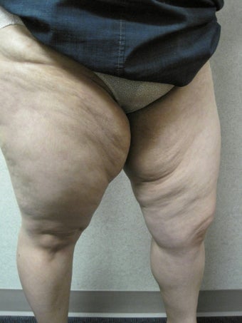 Inner Thigh Lift before 328655