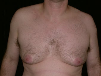 Gynecomastia Reduction Surgery before 233769