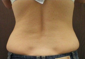 Lipo for Back and Love Handles before 374881
