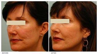 Acne Scarring Correction before 136793