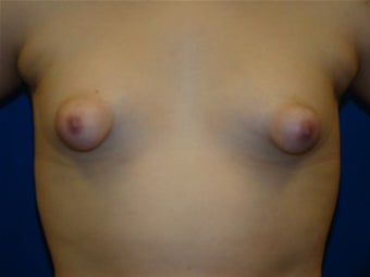 Tuberous Breasts, Breast Augmentation Surgery before 143625