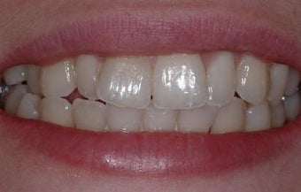 INVISALIGN before 257923