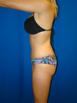Breast Augmentation, Mommy Makeover, Tummy Tuck (Abdominoplasty) 391987