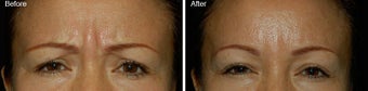 Botox for brow lines before 97874