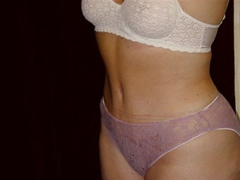 Tummy Tuck after 269289