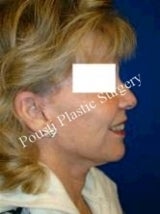 Face Lift, Neck Lift 632177