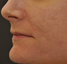 Acne Scarring 426028