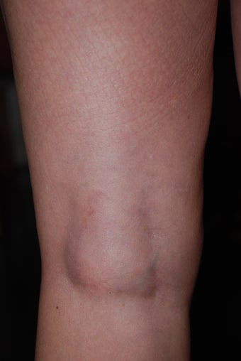 Sclerotherapy after 470090