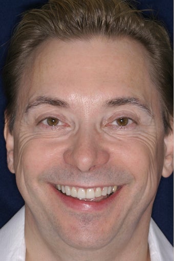 Porcelain Veneers before 423730