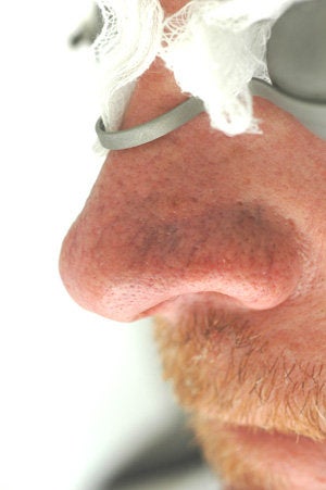 Nose spider vein removal before 106563