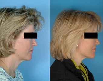 Facelift before 470234