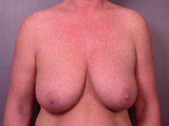 Breast Lift before 321468