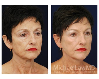 Facial Rejuvenation after 395250