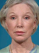 Facelift, eyelid surgery, neck & brow lift after 458802