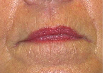 Juvederm effacement of perioral lines before 84413