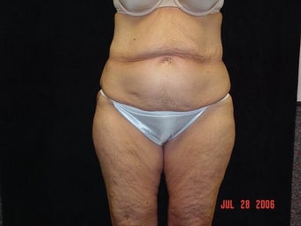 Body Lift with Liposuction of Abdomen, Waist, and Flanks before 203457